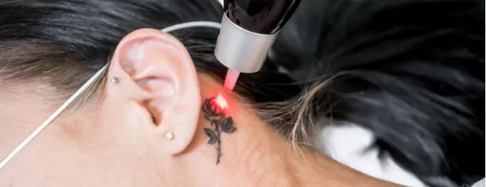 Remoção de Tatuagem,